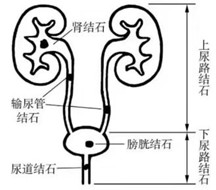 多么痛的領(lǐng)悟——尿石癥
